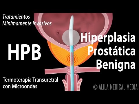 , title : 'Hiperplasia Prostática Benigna, HPB,  y Tratamientos. Alila Medical Media Español.'