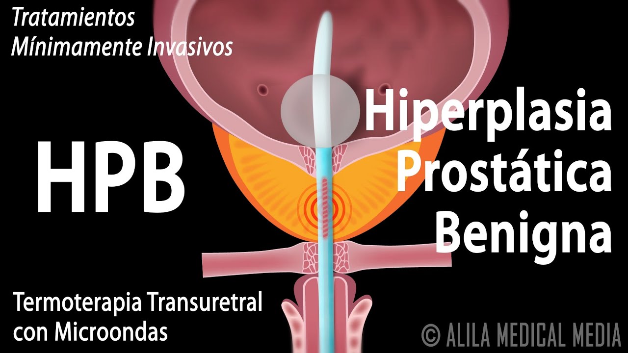 Hiperplasia Prostática Benigna, HPB, y Tratamientos. Alila Medical Media Español.