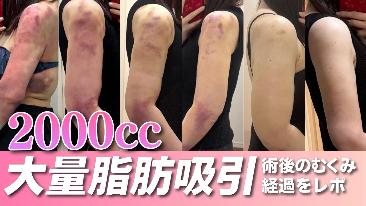 【大量吸引】二の腕から2000cc｜内出血、むくみ公開