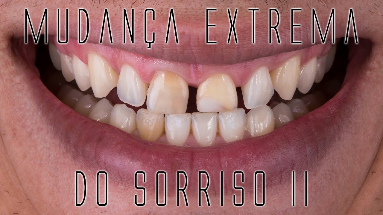 Mudança extrema do sorriso II: Os bastidores das facetas e lentes de contato dentais