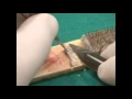 Hair Transplant Surgery Performed At Harley Street Hair Transplant Clinic