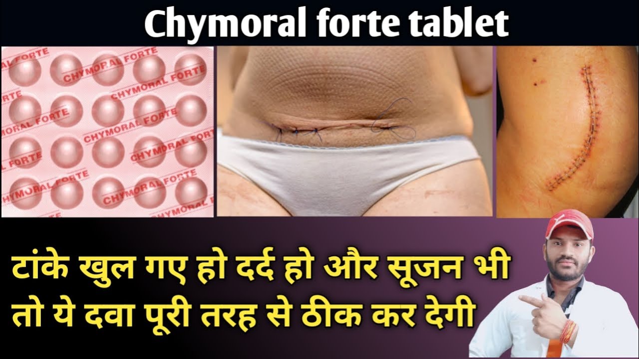 Watch video Chymoral forte tablet use dose benefits and side effects full review in hindi Now Chymoral forte tablet use dose benefits and side effects full review in hindi