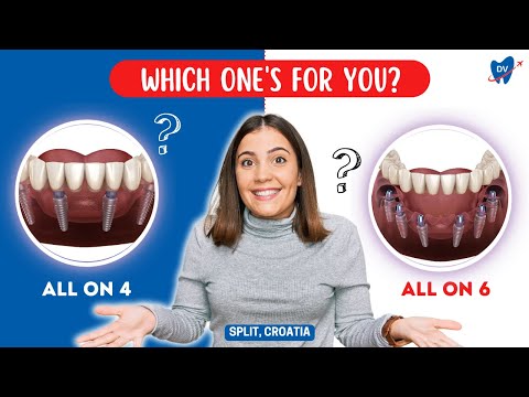 All on 4 vs All on 6 Dental Implants in Croatia: Make The Right Choice!