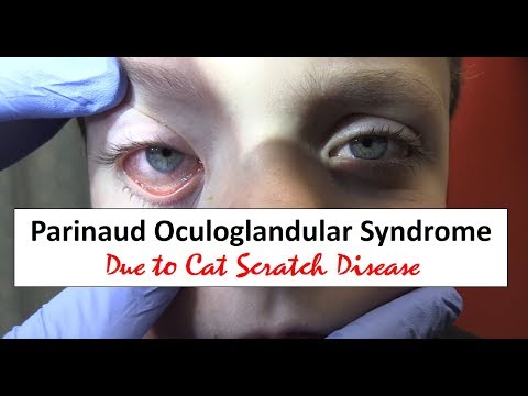 Parinaud Oculoglandular Syndrome and Cat Scratch Disease