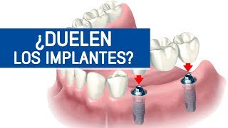 ¿Duelen los implantes dentales / Odontoespecialistas