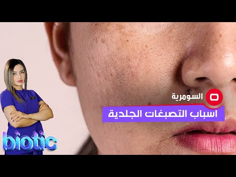 شاهد بالفيديو.. ما هي اسباب التصبغات الجلدية؟