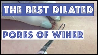 My Best Dilated Pores of Winer: A Dr Pimple Popper Compilation