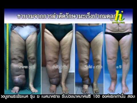 คลินิกเต้านมพลาสติกคาร์คอฟ หน้าอกพลาสติกท่อก่อนหลัง