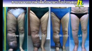 รายการพิชิตมะเร็ง 25กย57 อาหารแสลงในผู้ป่วยมะเร็งเต้านม มะเร็งปากมดลูก รายการพิชิตมะเร็ง 25กย57 อาหารแสลงในผู้ป่วยมะเร็งเต้านม มะเร็งปากมดลูก