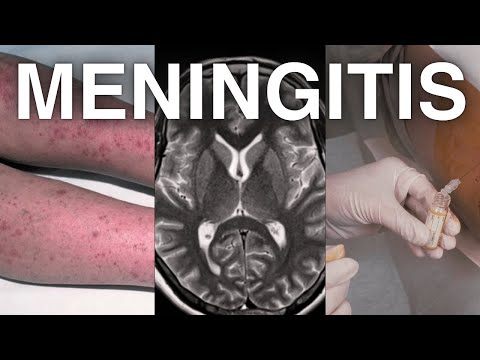 Puntos Clave Meningitis 2025