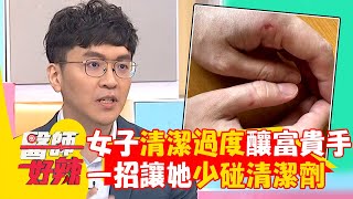 新手媽媽清潔過度導致「富貴手」！ 「一招」讓她少碰清潔劑改善症狀！【#醫師好辣】20241020 EP1676 part2