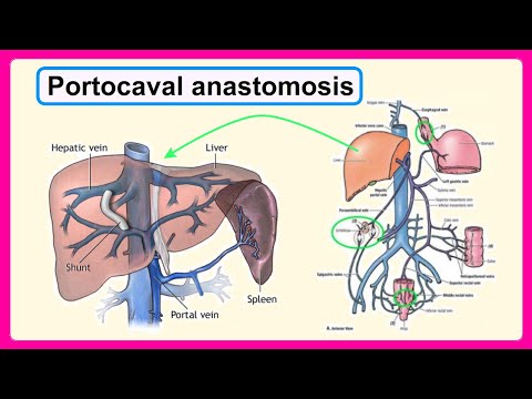 portocaval anastomosis
