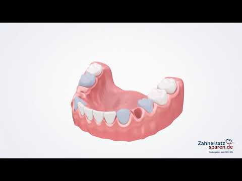 Behandlungsablauf: Flexprothese - Zahnersatzsparen.de