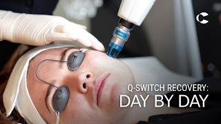 Krystal's Q-Switch Laser Recovery - What to Expect After Treatment