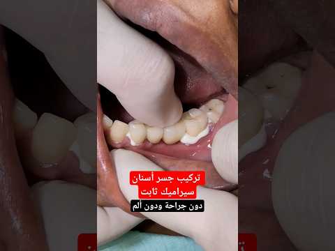 تركيب جسر اسنان سيراميك ثابت