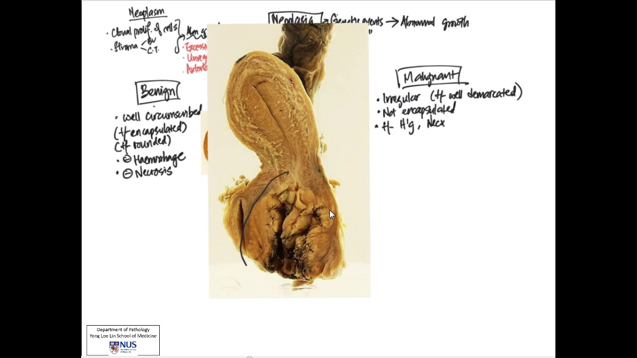 Neoplasia 2 Morphology