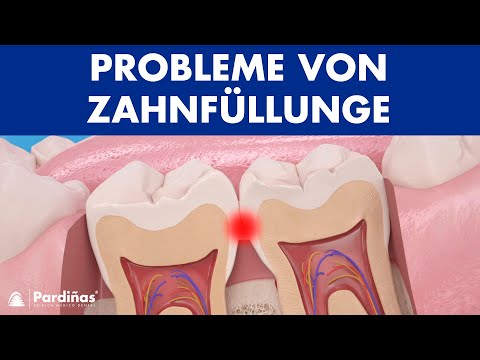 Probleme von Zahnfüllungen ©