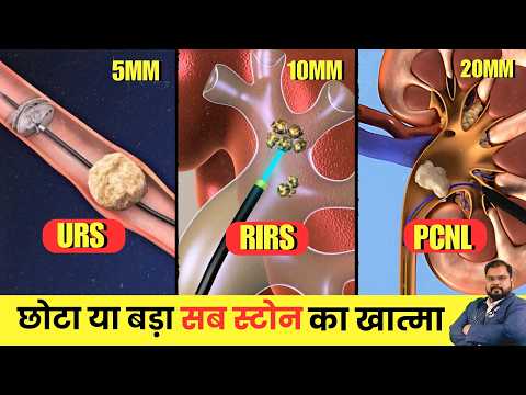 Kidney Stone 5mm - 20mm : कब दवा से निकलेगा और कब सर्जरी चाहिए?