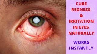 EYE IRRITATION|Home remedies for redness in eyes|Eye irritation home remedies[2020]