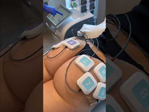 Cutera Tru Flex to the buttocks