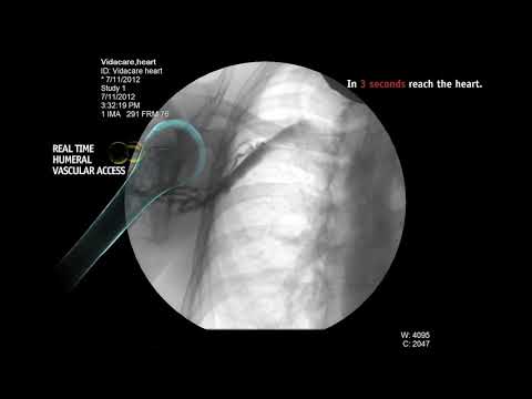 Intraosseous Infusion From Right Humeral Head
