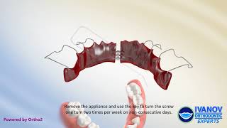 Schwartz Expander Appliance