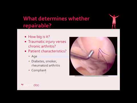 Cartilage Injury - Overview of Surgical Treatments