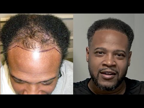 African American FUE Hair Transplant Before and After...