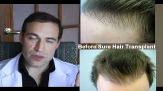 preview picture of video 'Amazing Hair transplant repair- Toronto Canada | (416)-747-7873'