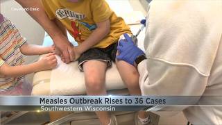 Measles outbreak spreads to Grant County, 36 confirmed cases across southwestern Wisconsin