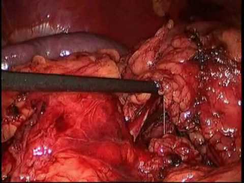 Left Laparoscopic Partial Nephrectomy - Part 1
