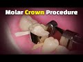 Step by Step Dental Crown Procedure (Glidewell Fastmill.io Posterior Back Molar Single Crown)