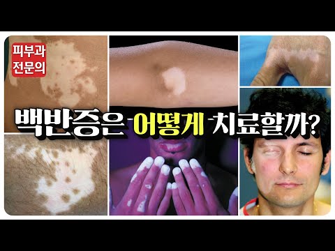 백반증은 어떻게 치료할까? 백반증 치료 원리에 대해서 자세하게 알려드림!