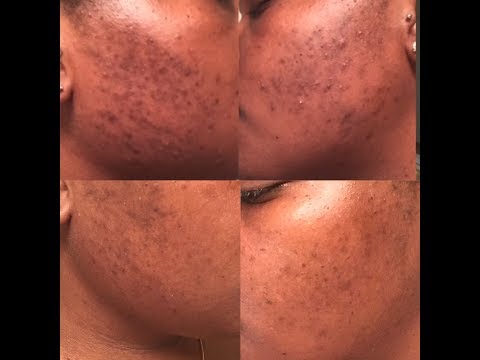 SKIN CHRONICLES| How I Got Rid Of My Acne Scars