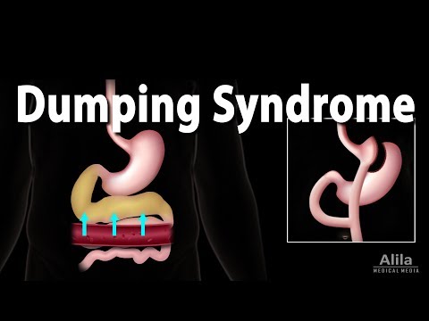Dumping Syndrome, Animation