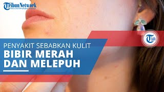 Herpes Labialis, Penyakit yang Menyebabkan Kulit di Sekitar Mulut Menjadi Merah, Melepuh, dan Berair