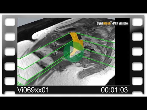 DynaMesh® MRI - Animation: MRI Reconstruction with DynaMesh®-PRP visible