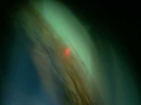 SLT Clinical Footage: Treatment Protocol