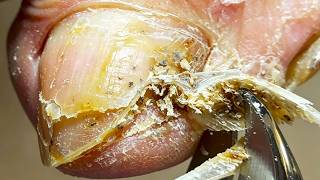 Dry, Rotten Toenails, Slowly Peel Off The Harmful Parts【Xue Yidao】