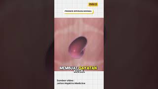 Download lagu Hernia surgery process mp3 Download lagu Hernia surgery process mp3