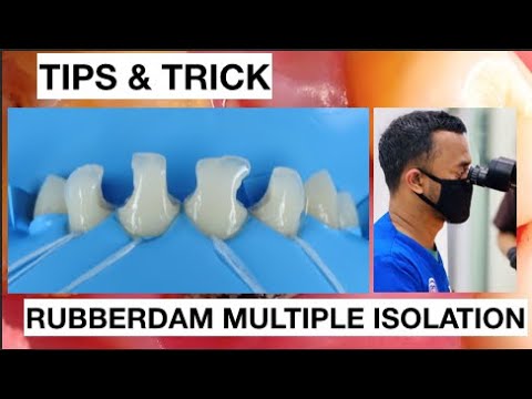 Tips and Trick Isolation With Rubberdam Multiple Anterior Without Clamp