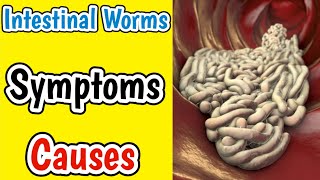 Intestinal Worms | Signs, Symptoms, Causes Of Intestinal Worms | Tapeworm, Hookworm Infection |