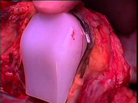 LFK cervicale Butrimova osteocondrosi Trattamento di osteocondrosi popolare