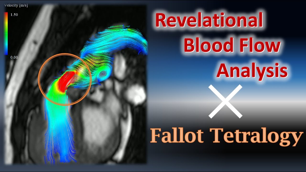 iTFlow Case#1_Tetralogy of Fallot