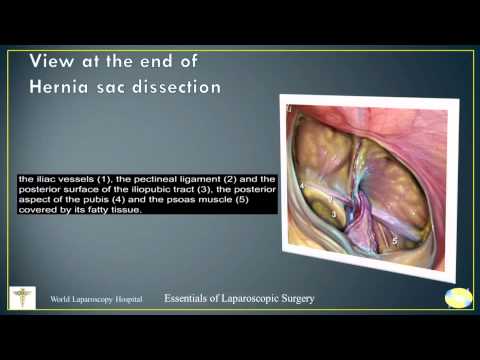 Reparación de hernia por vía transabdominal preperitoneal (TAPP)