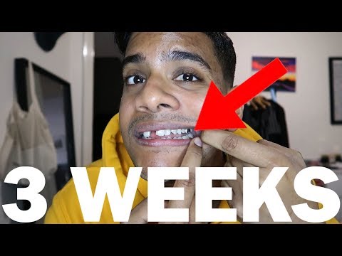 3-Weeks Post-Op - Jaw Expansion Surgery (SARPE) The Struggles!