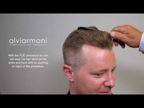 Consistently Excellent Hair Transplant Results by the...