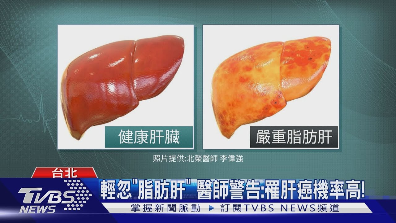 體重不控制!脂肪肝合併「糖尿病」醫警告這個癌 找上你