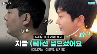 [리얼모델 VLOG] 지금 (턱)선 넘으셨어요❤️‍｜미니거상, 이근묶, 얼지흡 4달 경과 리얼 후기 #일퍼센트성형외과