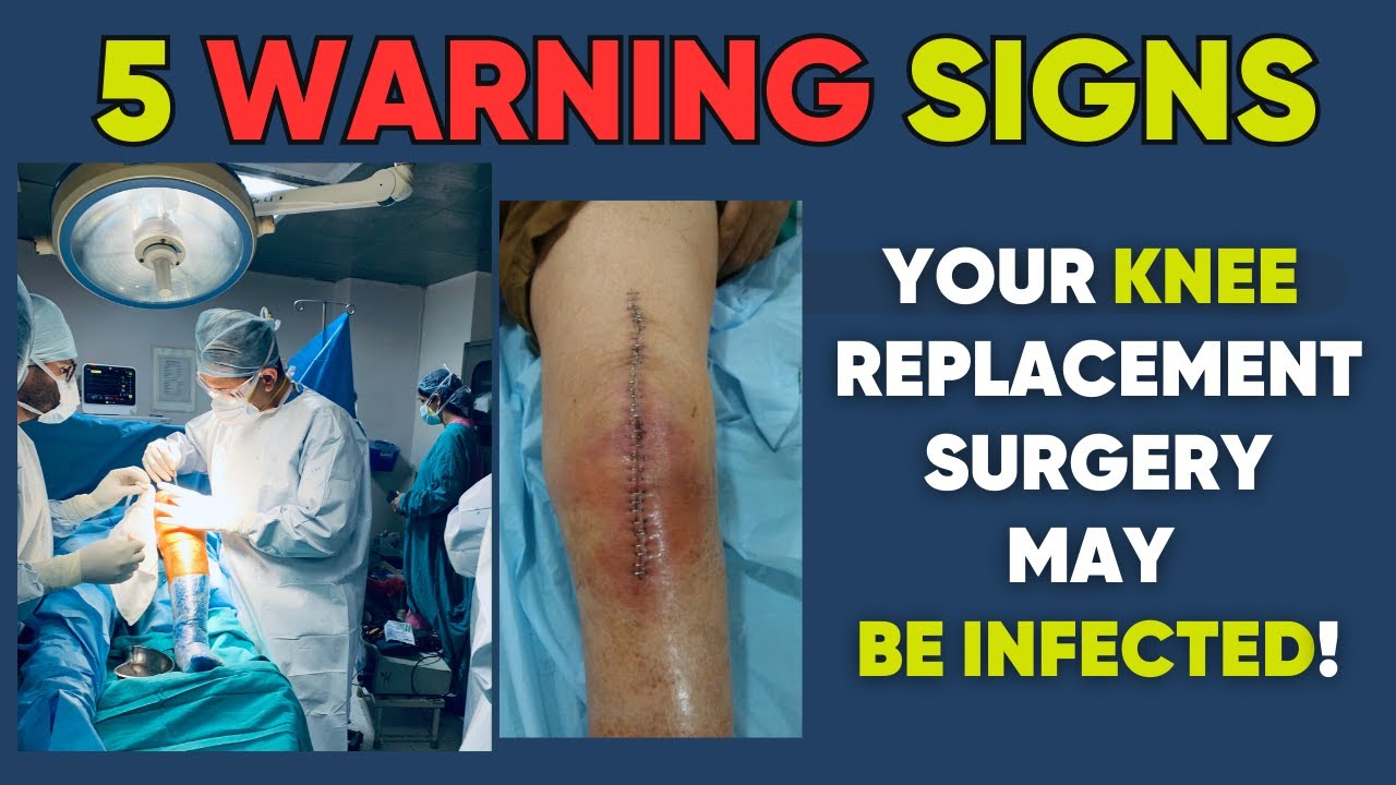 Top 5 warning signs of infection in knee replacement I घुटने की सर्जरी के बाद infection के 5 संकेत !